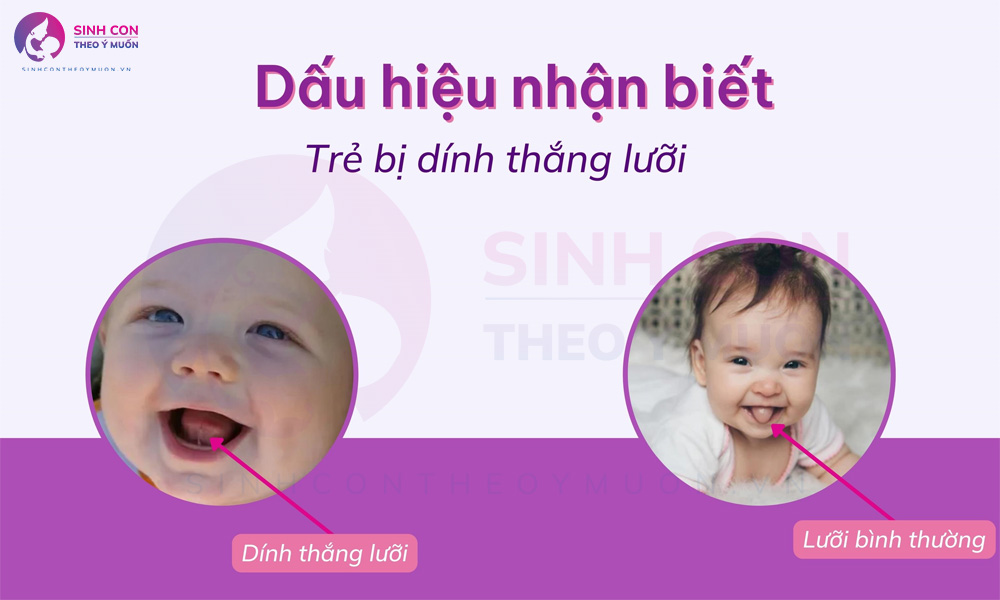 Dấu hiệu nhận biết dính thắng lưỡi