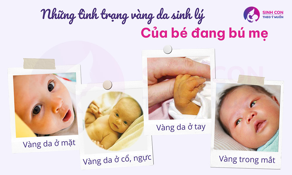 tinh trang vang da sinh ly cua be dang bu me